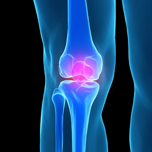X-ray style image of a knee joint with a highlighted painful/inflamed area in pink.